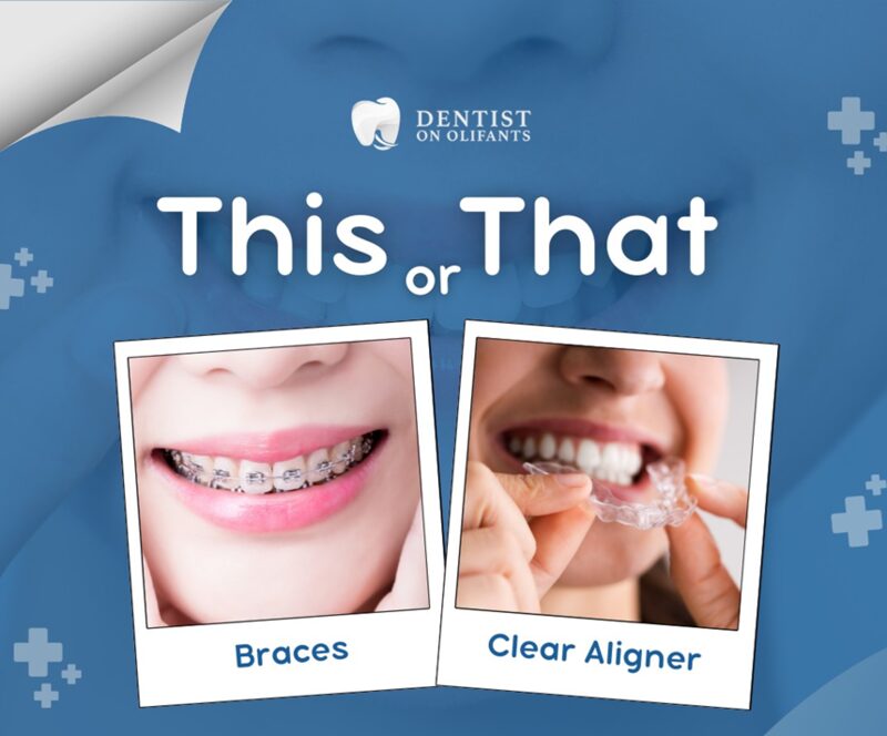 Braces and clear aligner services at Dentist On Olifants