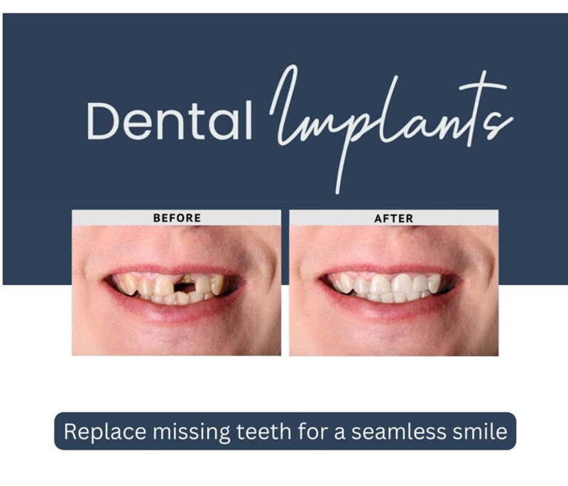 Dental implant services at Dentist On Olifants