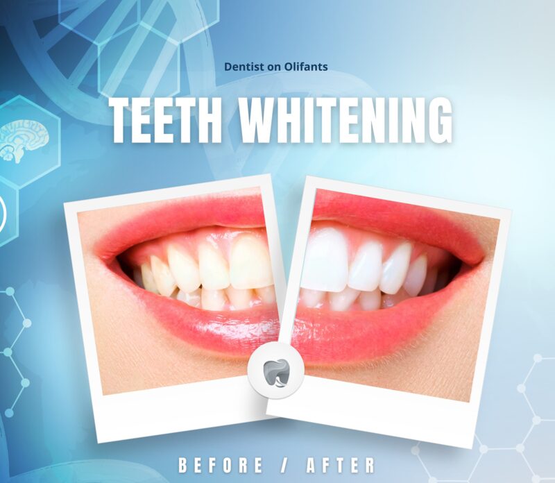 Teeth whitening services at Dentist On Olifants